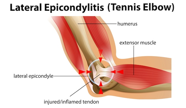 Vector gratuito epicondilitis lateral o codo de tenista