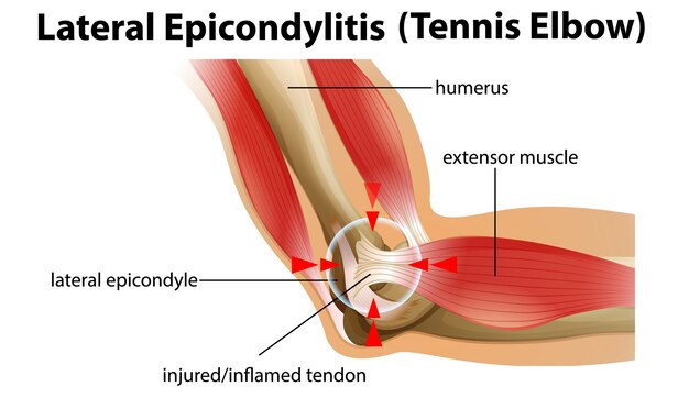 Epicondilitis lateral o codo de tenista