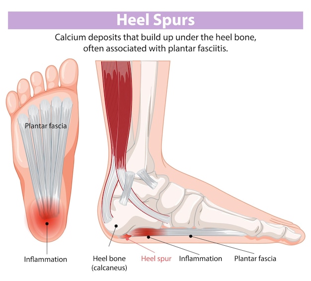 Los espolones del talón y la fasciitis plantar