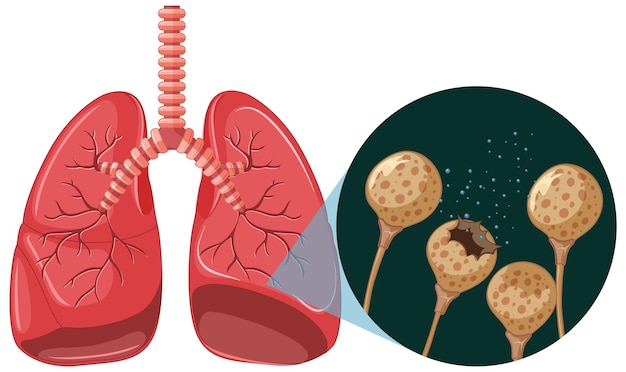 Vector gratuito las esporas de moho crecen en los pulmones humanos