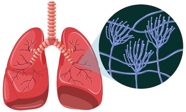 Las esporas de moho crecen en los pulmones humanos