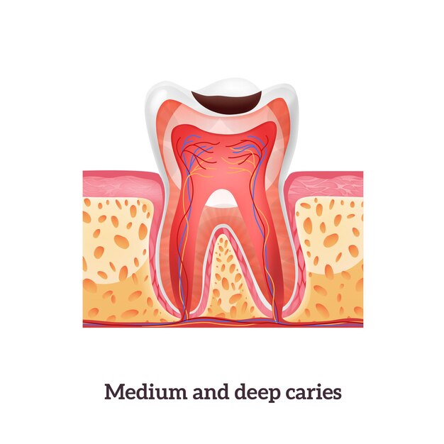 Estructura dental realista con caries media y profunda.