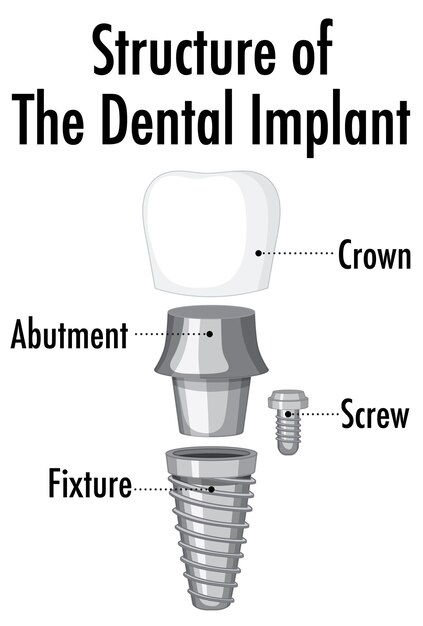 Estructura del implante dental sobre fondo blanco.