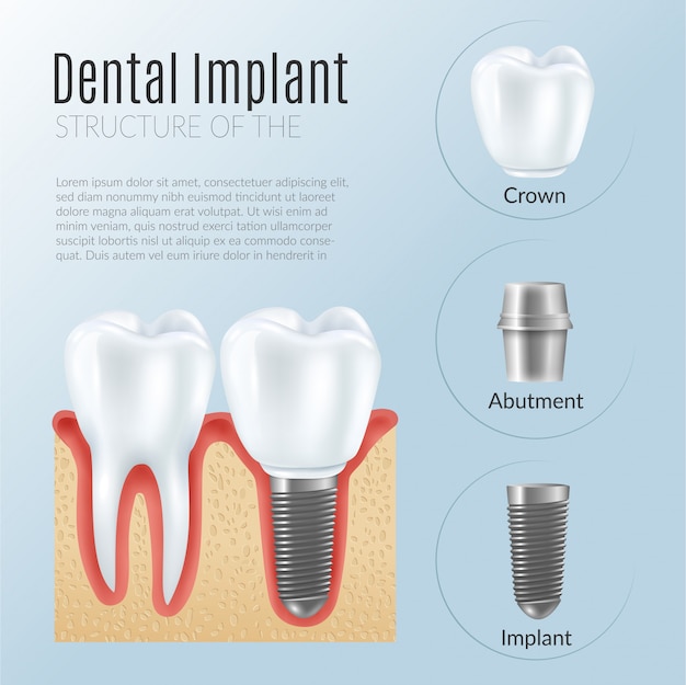 Estructura de la infografía de prótesis dental.