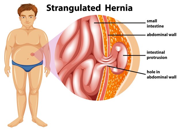 Hombre Diagrama De Hernia Estrangulada