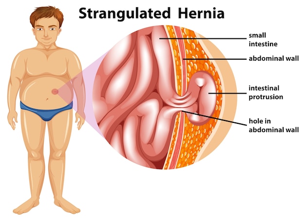 Hombre Diagrama De Hernia Estrangulada