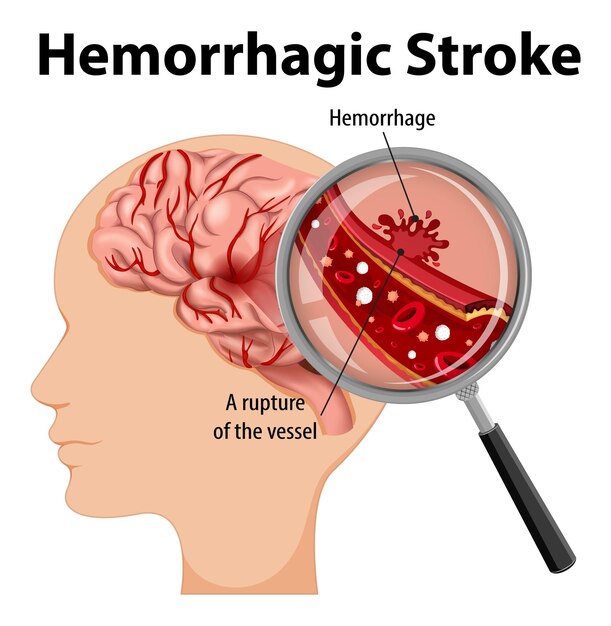 Humano con accidente cerebrovascular hemorrágico