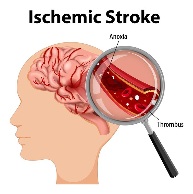 Humano con accidente cerebrovascular isquémico
