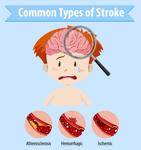 Humano con tipos comunes de accidente cerebrovascular