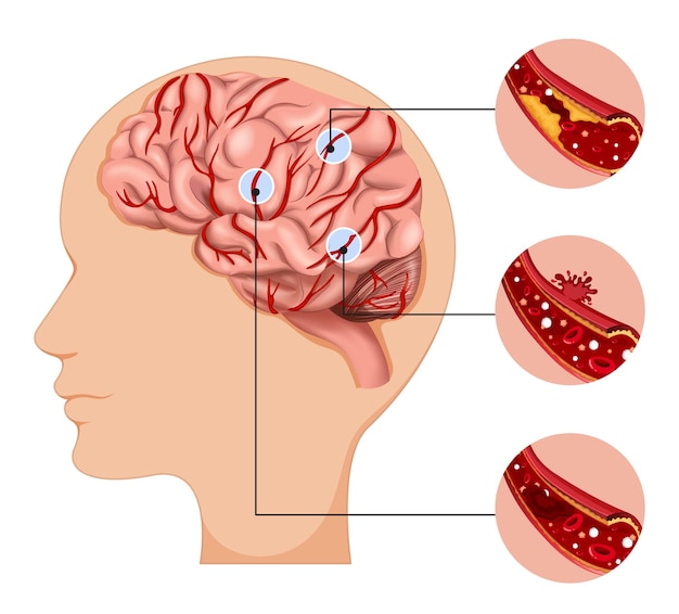 Humano con tipos comunes de infografía de accidente cerebrovascular