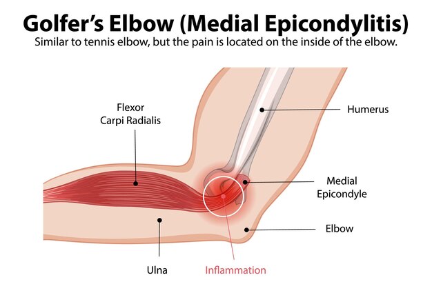 Ilustración de la anatomía del codo de los golfistas