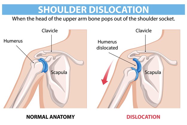 Ilustración de la anatomía de la dislocación del hombro