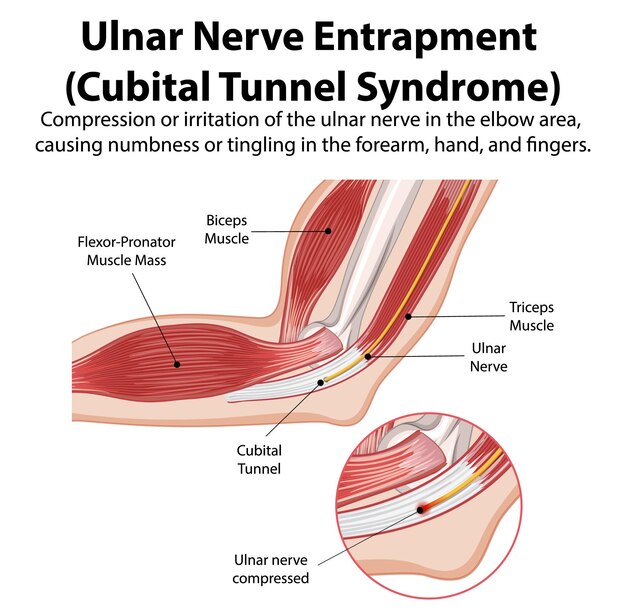 Ilustración del atrapamiento del nervio ulnar