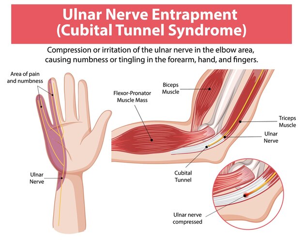 Ilustración del atrapamiento del nervio ulnar