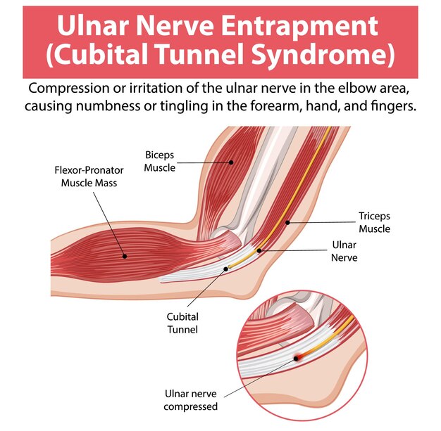 Ilustración del atrapamiento del nervio ulnar