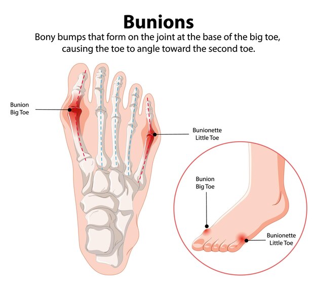 Ilustración de los buniones y los bunionetes