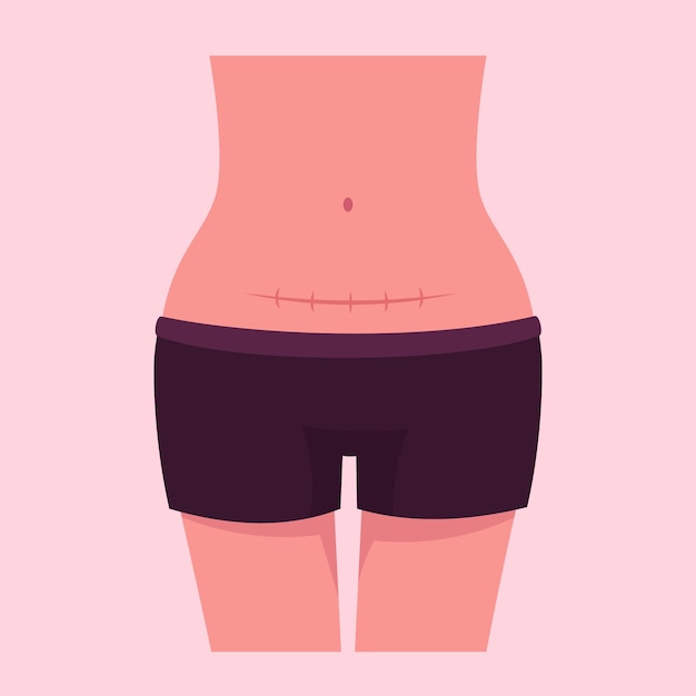 Ilustración de cesárea plana