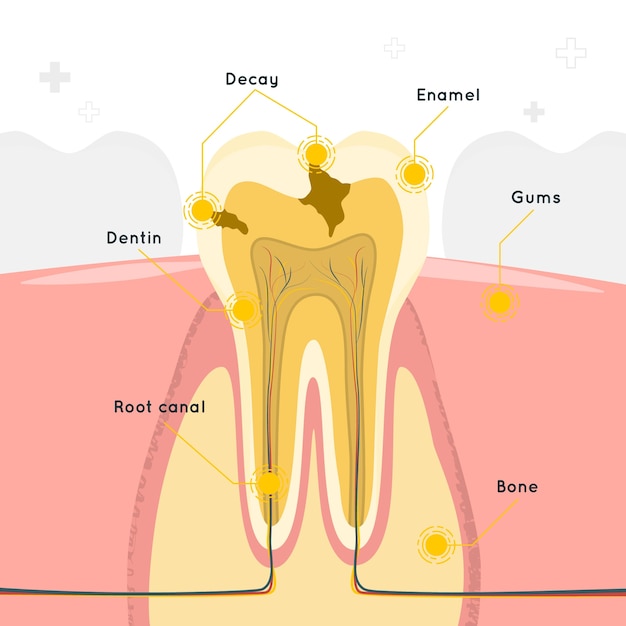 Ilustración del concepto de caries dental