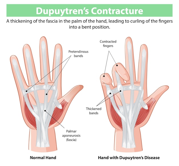 Ilustración de la contractura de Dupuytrens