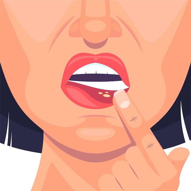 Ilustración de estomatitis de diseño plano