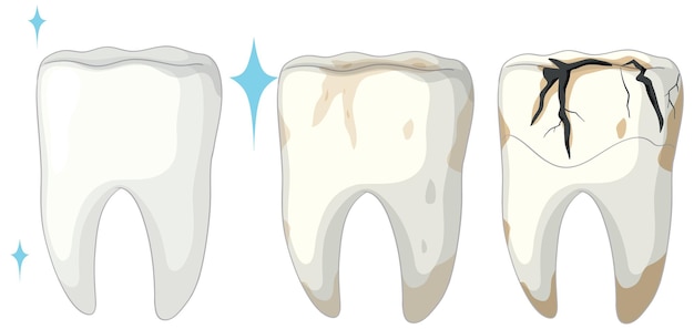 Ilustración de las etapas de la caries dental