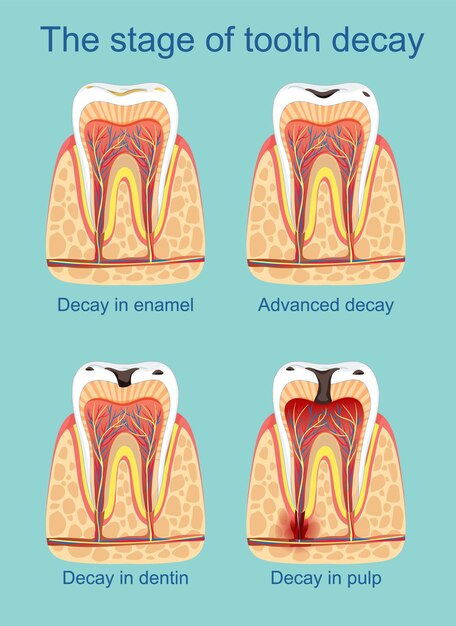 Ilustración de las etapas de la caries dental