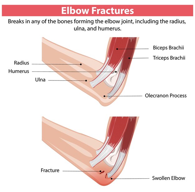 Ilustración de las fracturas del codo