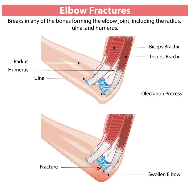 Ilustración de las fracturas del codo