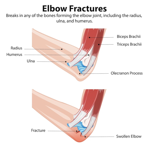 Ilustración de las fracturas del codo