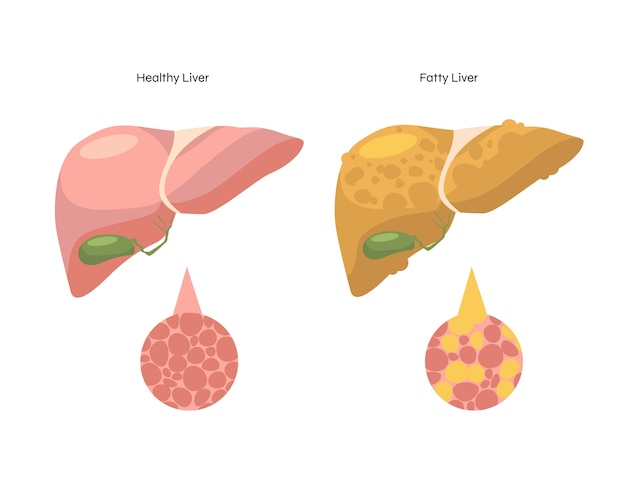 Vector gratuito ilustración de hígado graso de diseño plano dibujado a mano