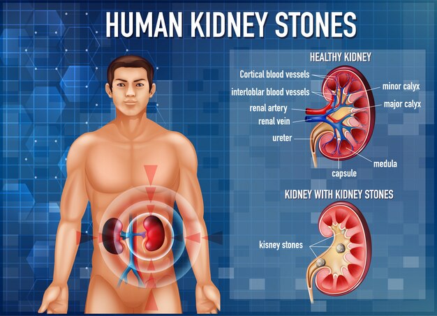Ilustración informativa de cálculos renales