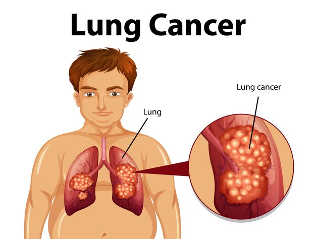 Ilustración informativa del cáncer de pulmón.