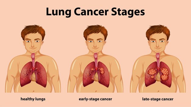 Ilustración informativa de las etapas del cáncer de pulmón.