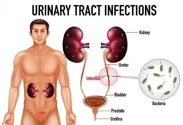 Ilustración informativa de infecciones del tracto urinario