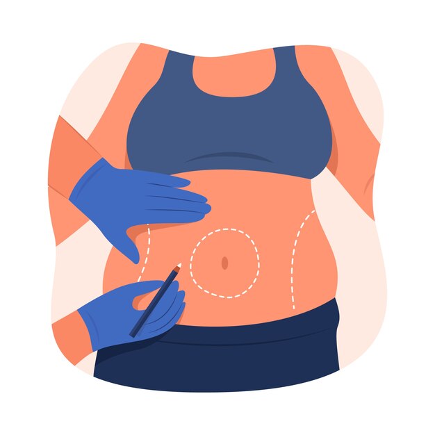 Ilustración de liposucción de diseño plano dibujado a mano