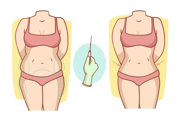 Ilustración de liposucción de diseño plano dibujado a mano