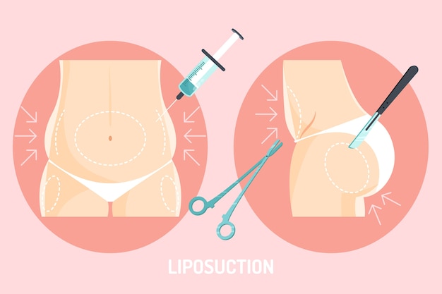 Ilustración de liposucción de diseño plano dibujado a mano