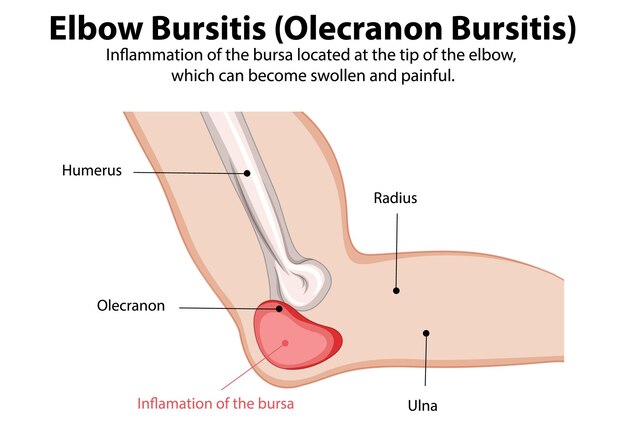Ilustración médica de la bursitis del codo
