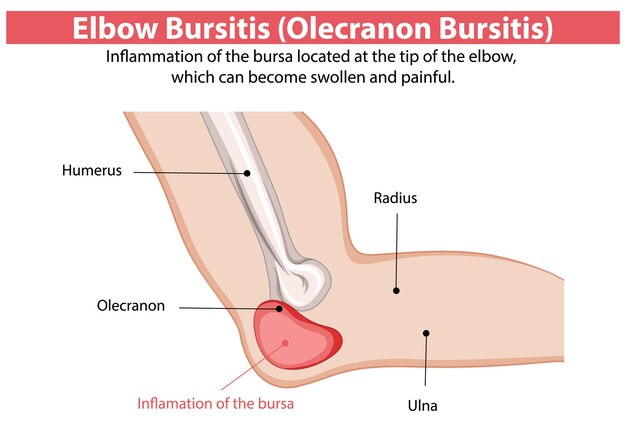 Ilustración médica de la bursitis del codo