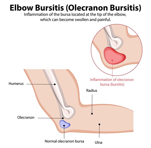 Ilustración médica de la bursitis del codo