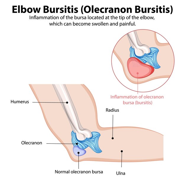 Ilustración médica de la bursitis del codo