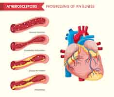 Vector gratuito ilustración médica científica de la aterosclerosis