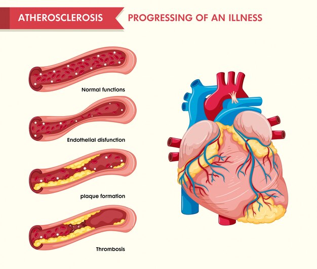 Ilustración médica científica de la aterosclerosis