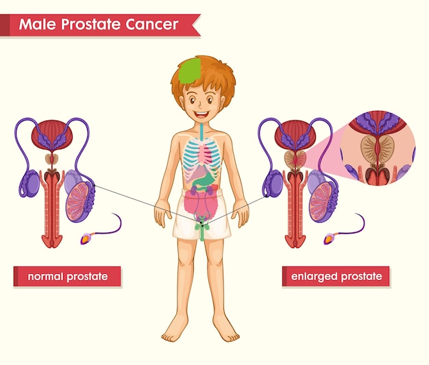 Vector gratuito ilustración médica científica del concepto de cáncer de próstata masculino