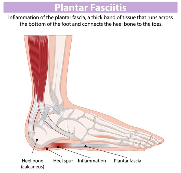 Ilustración médica de la fasciitis plantar