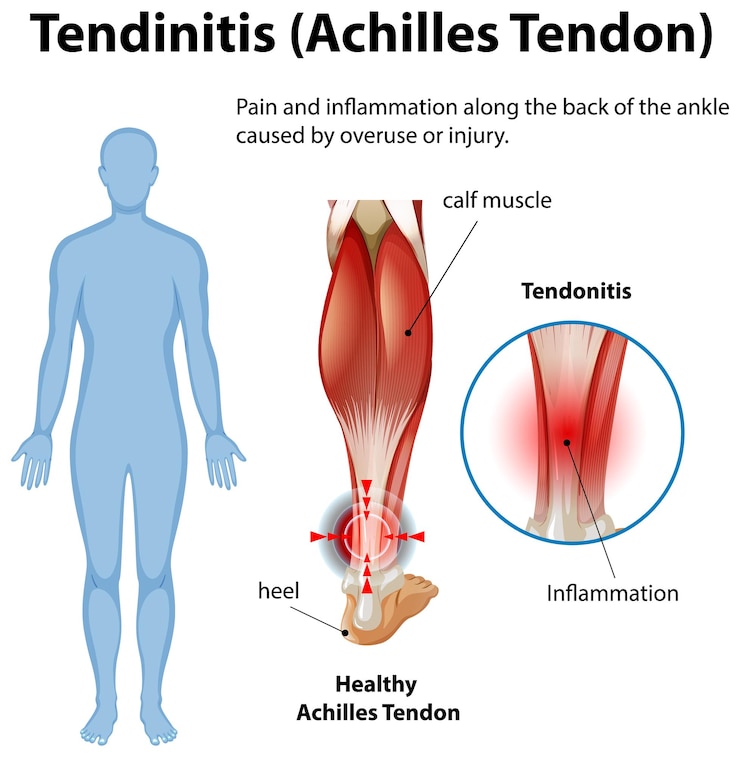 Vector gratuito ilustración médica de la tendonitis de aquiles