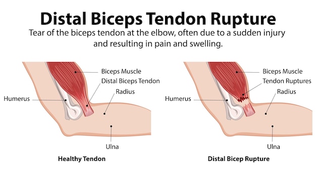 Ilustración de la ruptura del tendón del bíceps distal