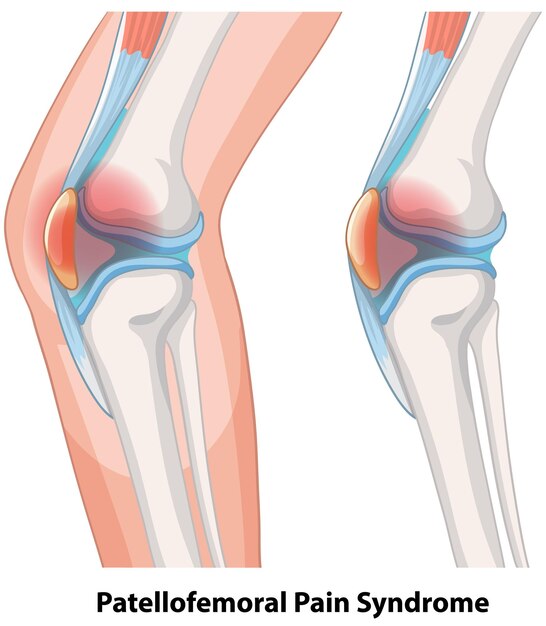 Ilustración del síndrome de dolor patelofemoral