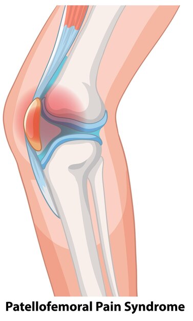 Ilustración del síndrome de dolor patelofemoral