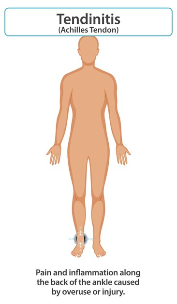 Ilustración y síntomas de la tendinitis de Aquiles